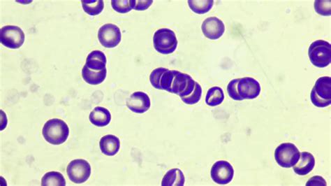 rouleaux formation symptoms.